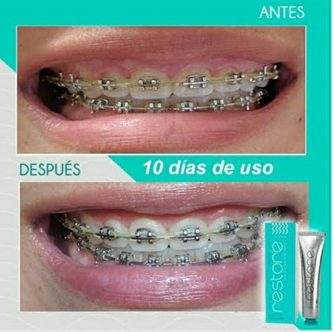 Image of RESTORE GEL DENTAL - Blanqueador con Nanotecnología